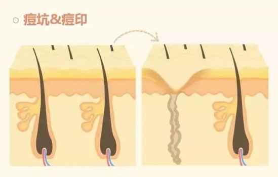 痘坑怎么修复 几种激光类型可以解决
