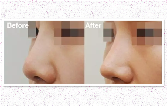 耳软骨垫鼻尖会歪吗 注意3点鼻尖不歪斜和移位