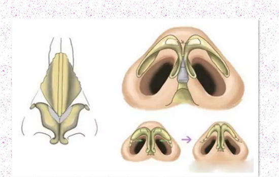 耳软骨隆鼻效果好吗 揭秘耳软骨垫鼻子效果是否自然