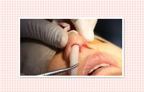 硅胶隆鼻多久完全恢复 鼻子两周自然完全康复需三个月