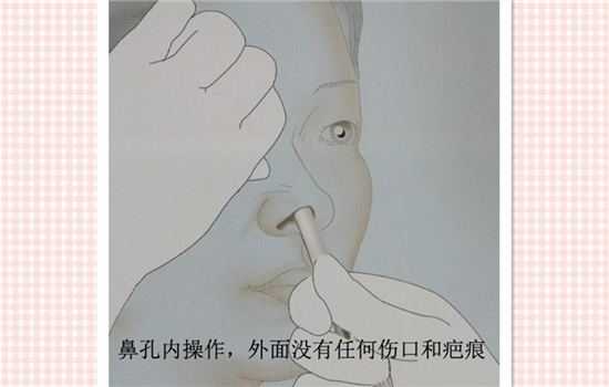 硅胶隆鼻会透光怎么办 硅胶鼻子变透明的真正原因