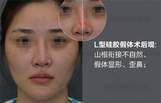 硅胶隆鼻失败案例 硅胶鼻整形失败原因及修复方法