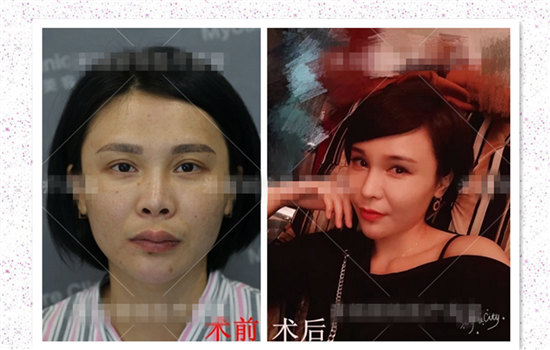 硅胶隆鼻失败案例 硅胶鼻整形失败原因及修复方法