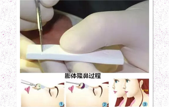 假体隆鼻要打消炎针嘛 硅胶和膨体隆鼻无需额外打消炎针