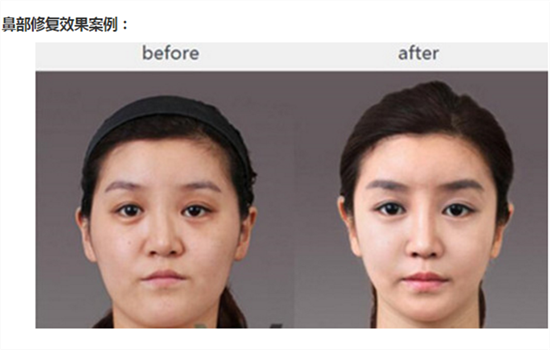 硅胶隆鼻取出多久消肿 隆鼻失败修复术后消肿至少需14天