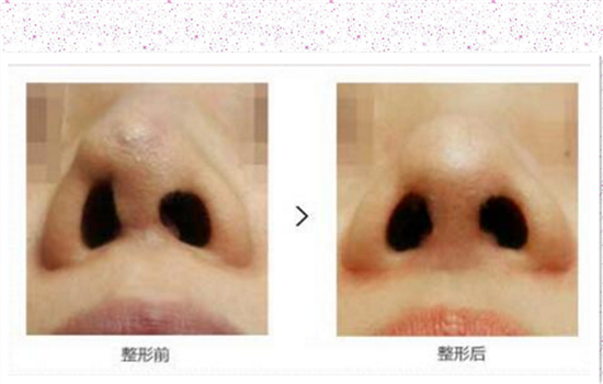硅胶隆鼻取出多久消肿 隆鼻失败修复术后消肿至少需14天