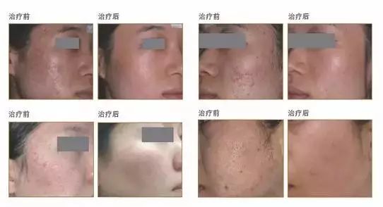 痘坑怎么修复 几种激光类型可以解决