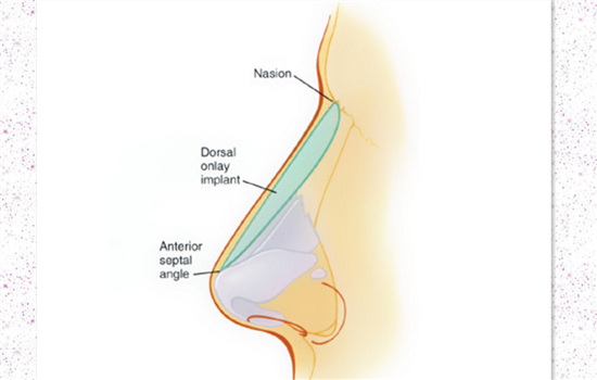 膨体隆鼻鼻头多久恢复 1个月消肿3-6个月软化至正常