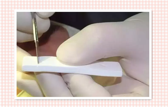 膨体隆鼻多久定型 手术完3个月后定型要注意那些问题