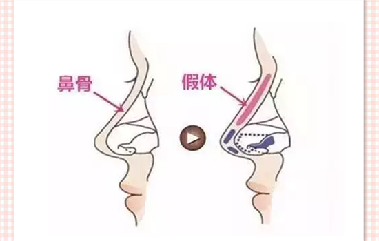 膨体隆鼻多久定型 手术完3个月后定型要注意那些问题