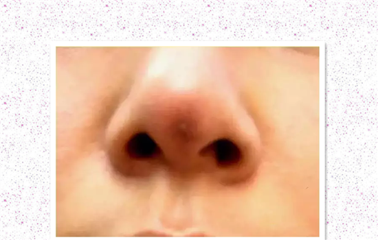 膨体隆鼻鼻梁发红 膨体鼻鼻背红解决方案你造吗