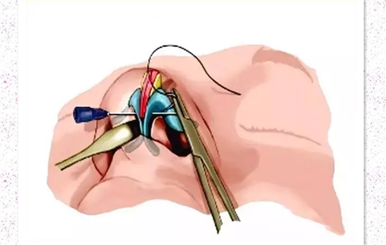 膨体隆鼻鼻梁发红 膨体鼻鼻背红解决方案你造吗