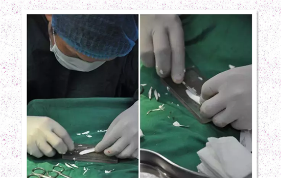 膨体隆鼻材料介绍 隆鼻膨体有哪些优缺点