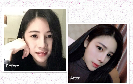 鼻翼缩小手术前后对比照片 改善鼻翼路人也能变女神