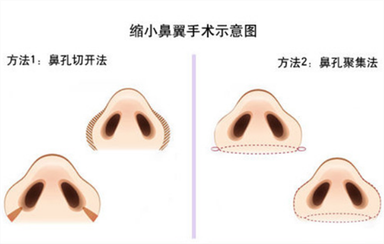 鼻翼缩小有什么后遗症 缩鼻翼后危害真的严重吗