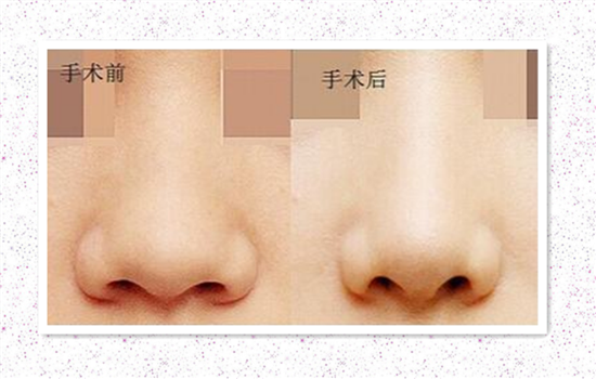 鼻翼缩小有什么后遗症 缩鼻翼后危害真的严重吗