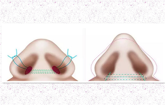 缩鼻翼后用嘴巴呼吸吗 鼻翼缩小是否影响正常呼吸