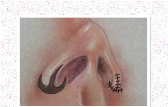 鼻翼外切有疤痕怎么办 这篇疤痕祛除攻略告诉你