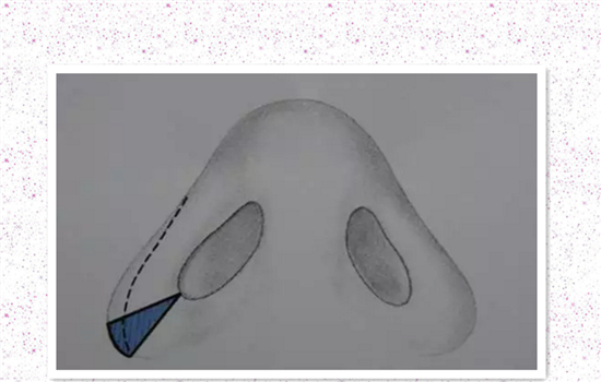 鼻翼外切有疤痕怎么办 这篇疤痕祛除攻略告诉你