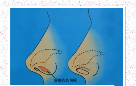 鼻翼外切有疤痕怎么办 这篇疤痕祛除攻略告诉你