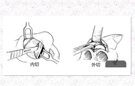 鼻翼内切是切鼻基底吗 内切鼻翼切口在鼻子里面