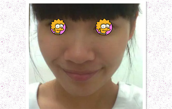 缩鼻翼内切外切原理图 多图详解内外切缩鼻翼