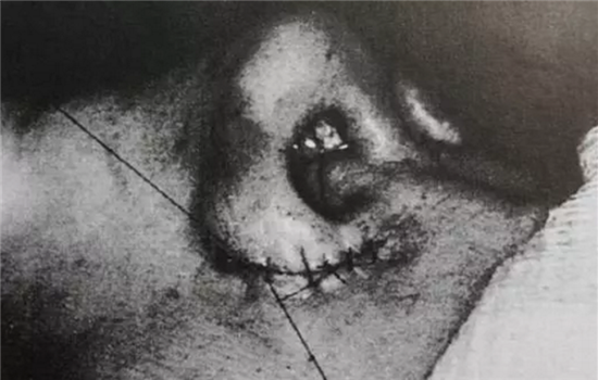 缩鼻翼内切外切原理图 多图详解内外切缩鼻翼