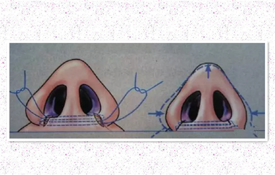 缩鼻翼内切外切原理图 多图详解内外切缩鼻翼