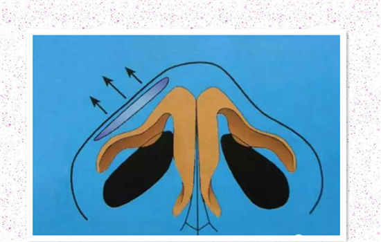 缩鼻翼内切外切原理图 多图详解内外切缩鼻翼