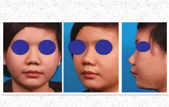 缩鼻翼内切外切原理图 多图详解内外切缩鼻翼