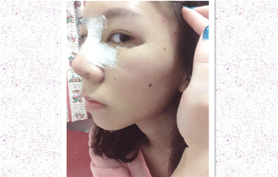 鼻翼缩小术恢复过程图 一个月后完全恢复基本无痕迹