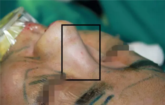 鼻子修复手术最佳时间 鼻子做坏了通常间隔6个月做修复