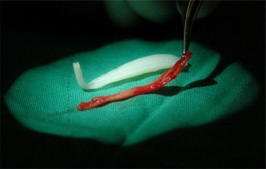 鼻子修复是怎么做的 多图解析隆鼻取出全部过程