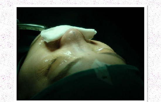 鼻子修复是怎么做的 多图解析隆鼻取出全部过程