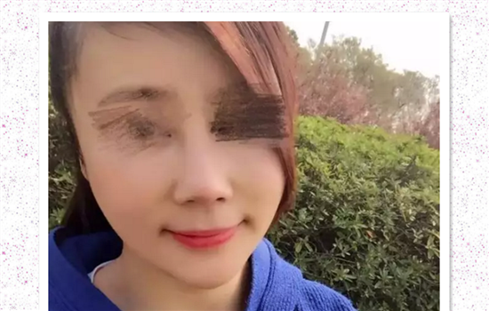 鼻修复失败案例 爱美者术前谨慎择医才能避免