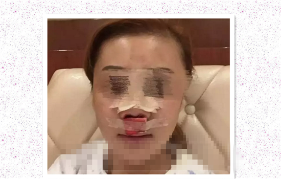 鼻修复失败案例 爱美者术前谨慎择医才能避免