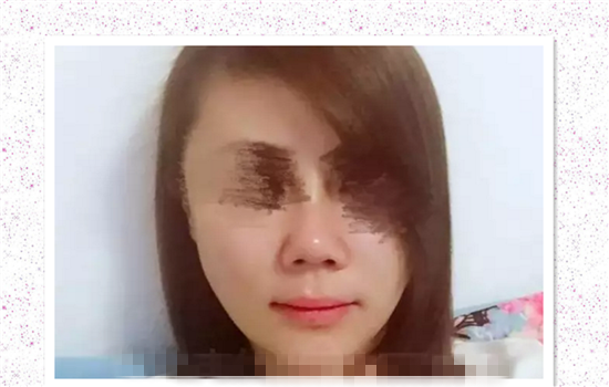 鼻修复失败案例 爱美者术前谨慎择医才能避免