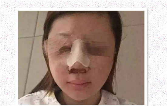 鼻修复失败案例 爱美者术前谨慎择医才能避免