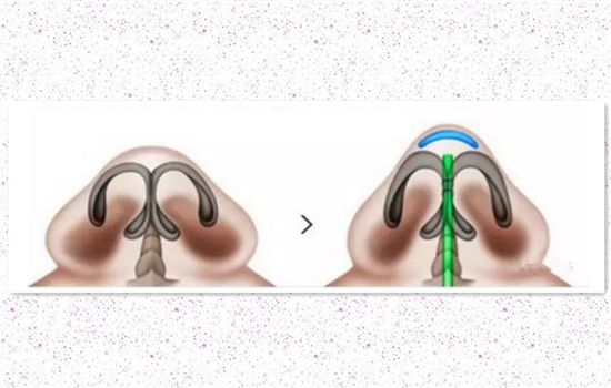 鼻头缩小的方法有哪些 收缩鼻头前必看