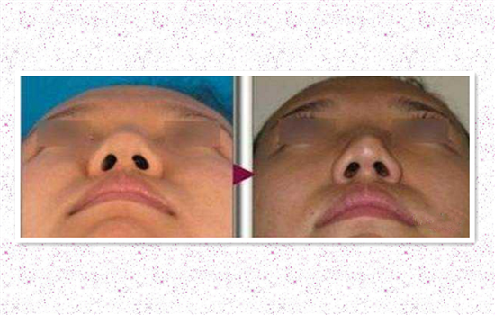 鼻头缩小会反弹吗 为什么说缩窄鼻头很有可能反弹