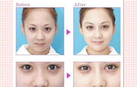 鼻头缩小增生怎么办 增生水肿期和非水肿期处理情况不同