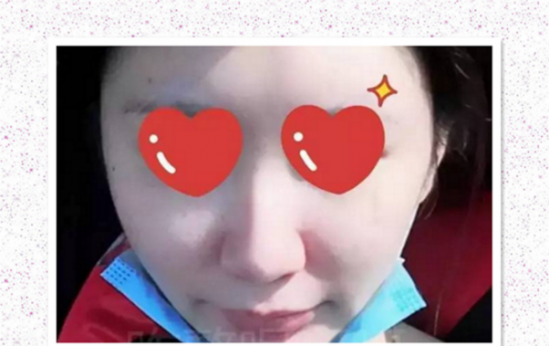 鼻翼内切效果图 真实日记记录鼻翼缩小历程