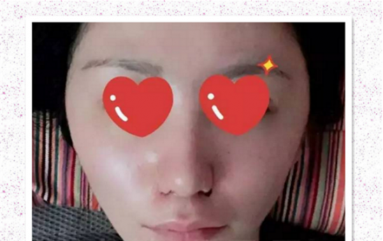 鼻翼内切效果图 真实日记记录鼻翼缩小历程