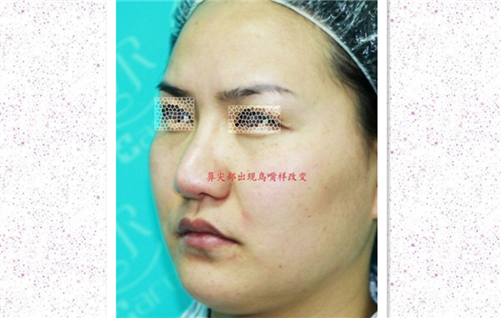 鼻头缩小术过程图 多图详解缩鼻头的奥秘