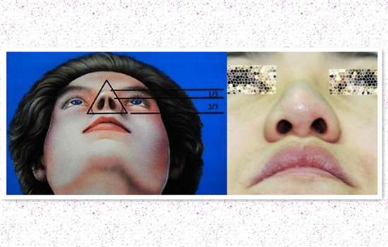 鼻头缩小术过程图 多图详解缩鼻头的奥秘