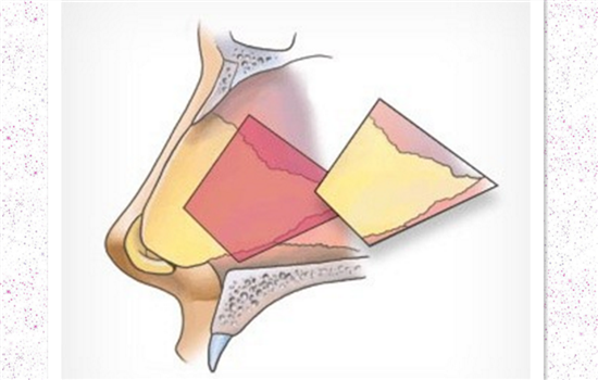 鼻小柱延长是永久的吗 术后妙鼻生花一辈子