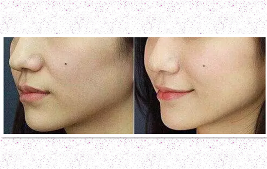 鼻小柱延长方法 千万不能用这种方法打造你的鼻子