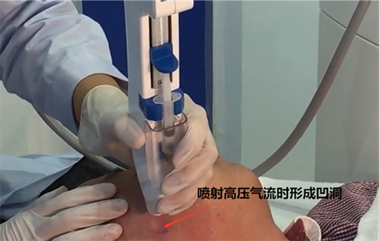 无针水光用什么产品 这三种玻尿酸产品最具代表性