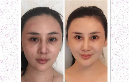 无针水光没效果 你还没弄清楚真正原因