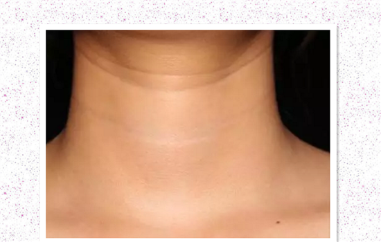 嗨体去颈纹能维持多久 怎样延长嗨体的保持效果